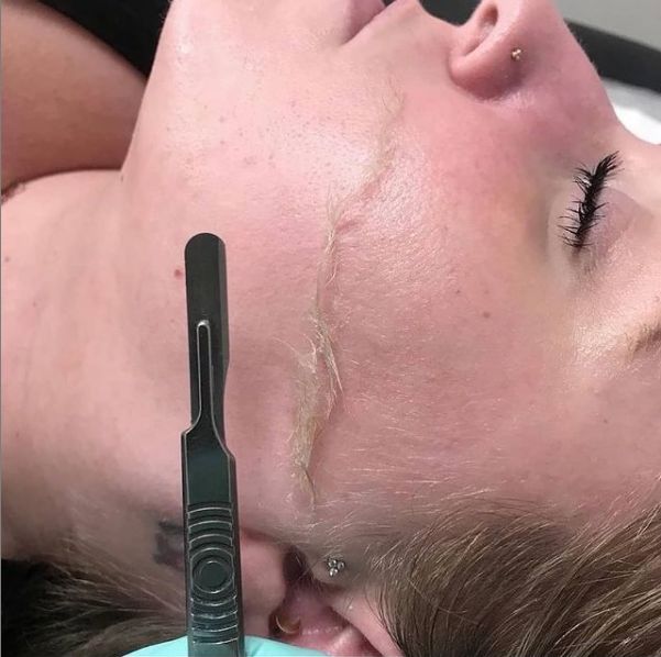 Facial- Dermaplaning